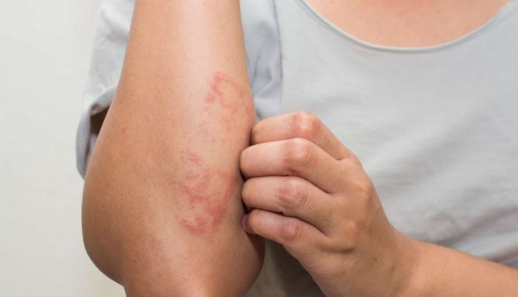 Chronique Aroma – L’Eczéma